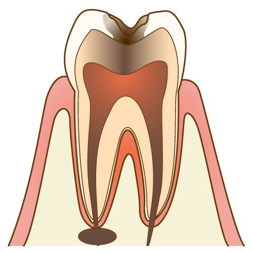 歯髄疾患