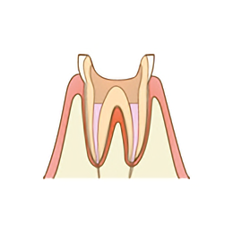 ひどいむし歯の治療の3